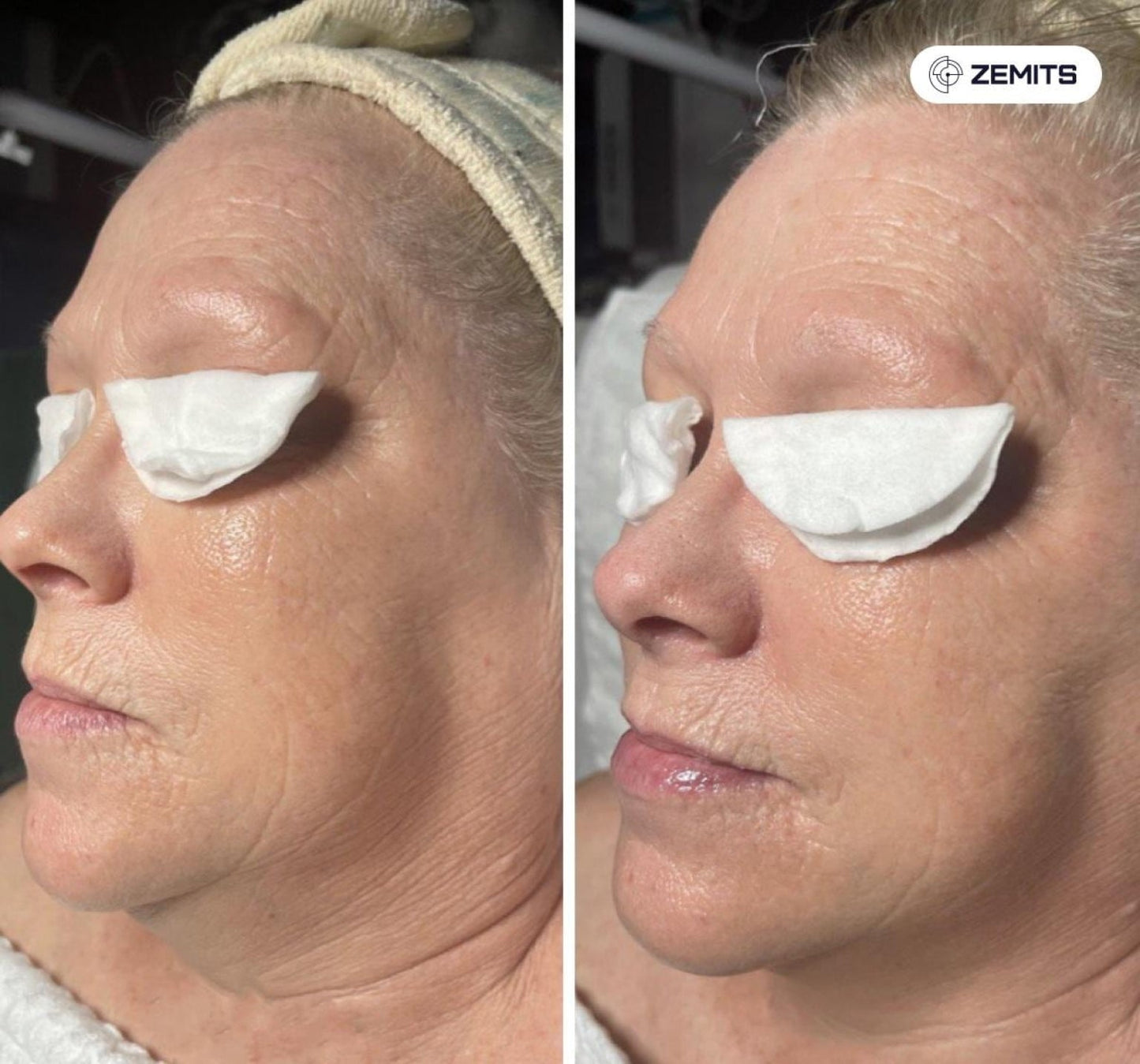 Zemits Klein EL Elektroporaatiojärjestelmä