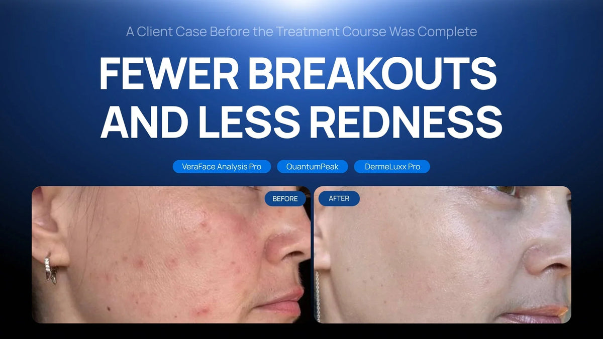 Fewer Breakouts and Less Redness