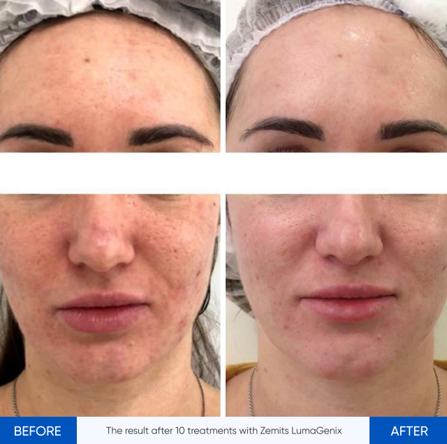 Zemits LumaGenix PDT Ammattilaiskäyttöön tarkoitettu LED-valoterapia-laite