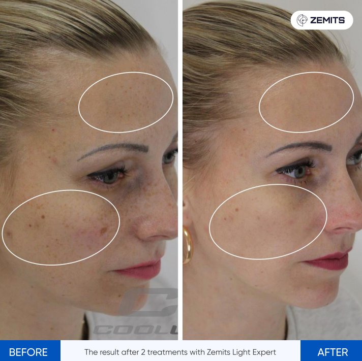 Zemits Light Expert 2.0 IPL-laserlaite