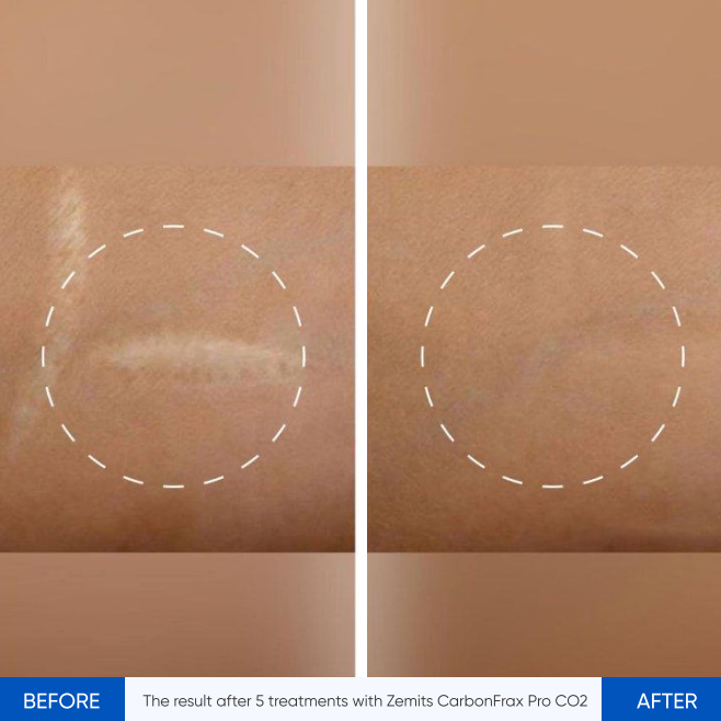 Zemits CarbonFrax Pro: CO2 fraktionaalinen laser
