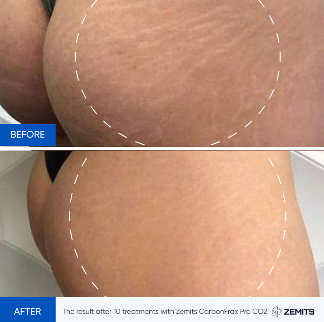 Zemits CarbonFrax Pro: CO2 fraktionaalinen laser