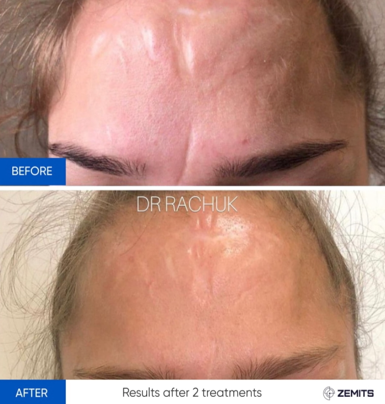 Zemits CarbonFrax Pro: CO2 fraktionaalinen laser