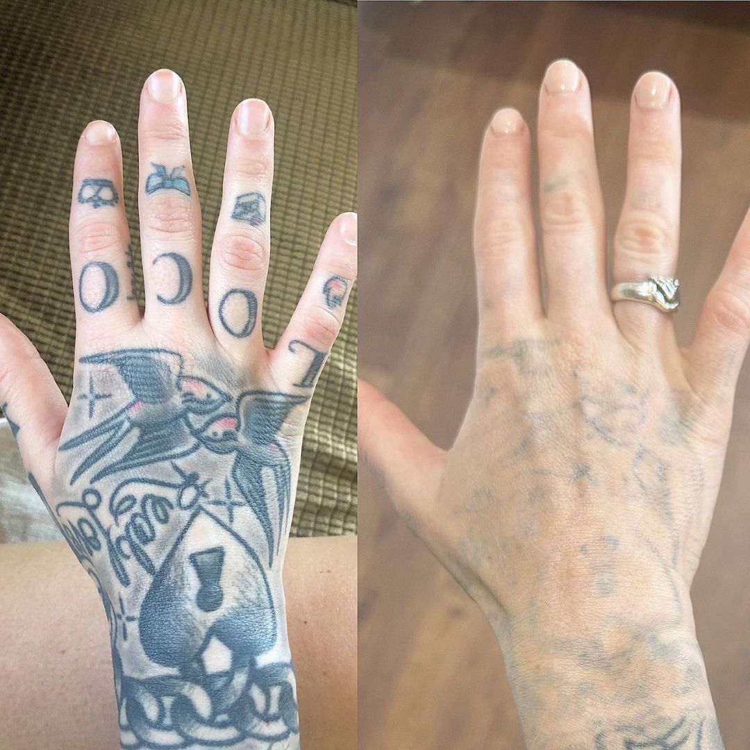 Zemits YAGenix Q-kytketty Nd:YAG-laser