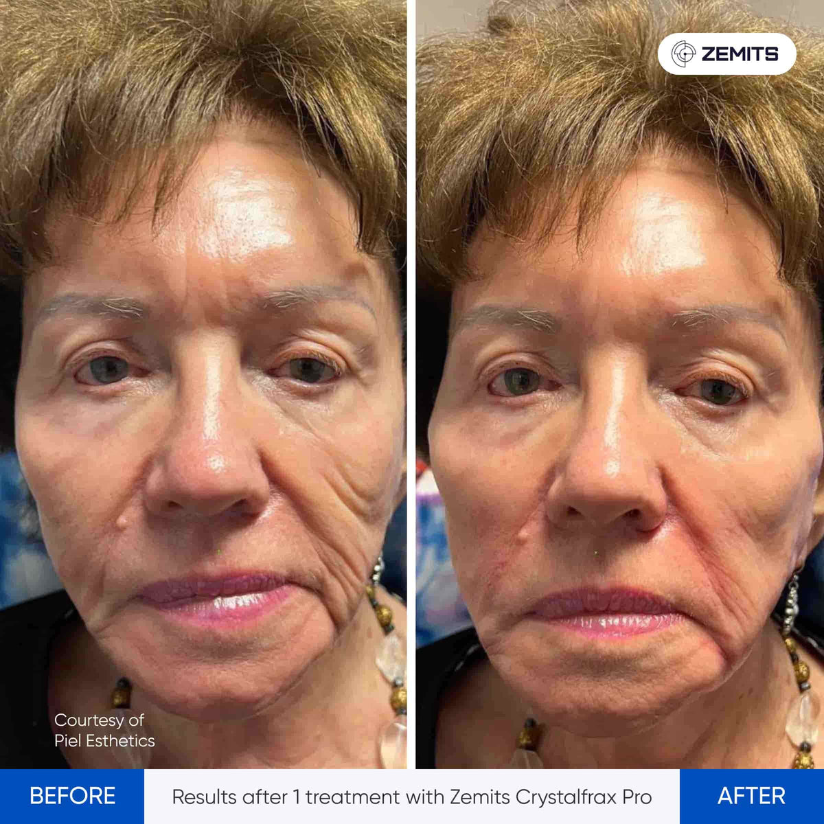 Before After Slide 2