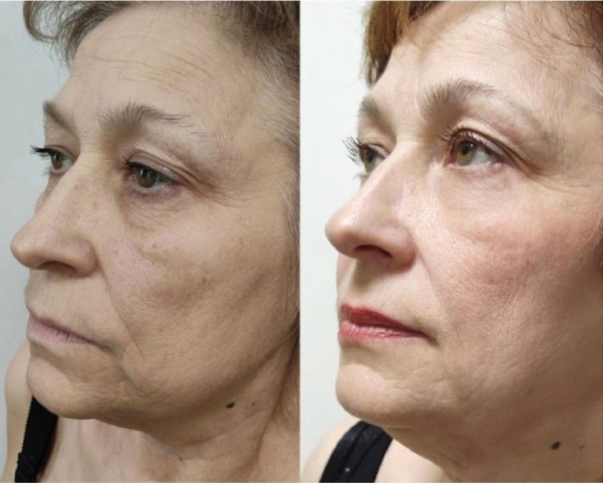 Zemits LumaGenix PDT Ammattilaiskäyttöön tarkoitettu LED-valoterapia-laite