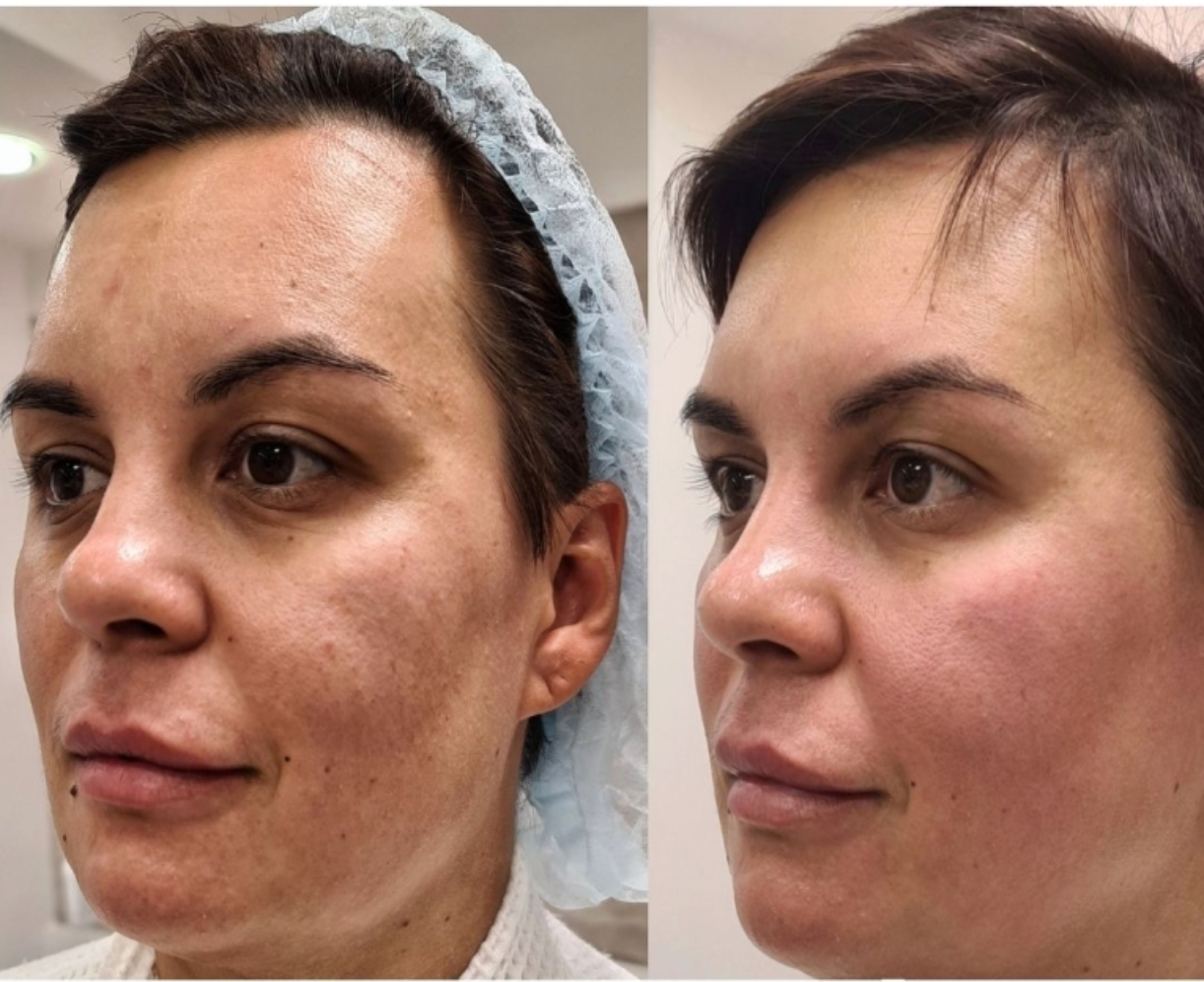 Zemits LumaGenix PDT Ammattilaiskäyttöön tarkoitettu LED-valoterapia-laite