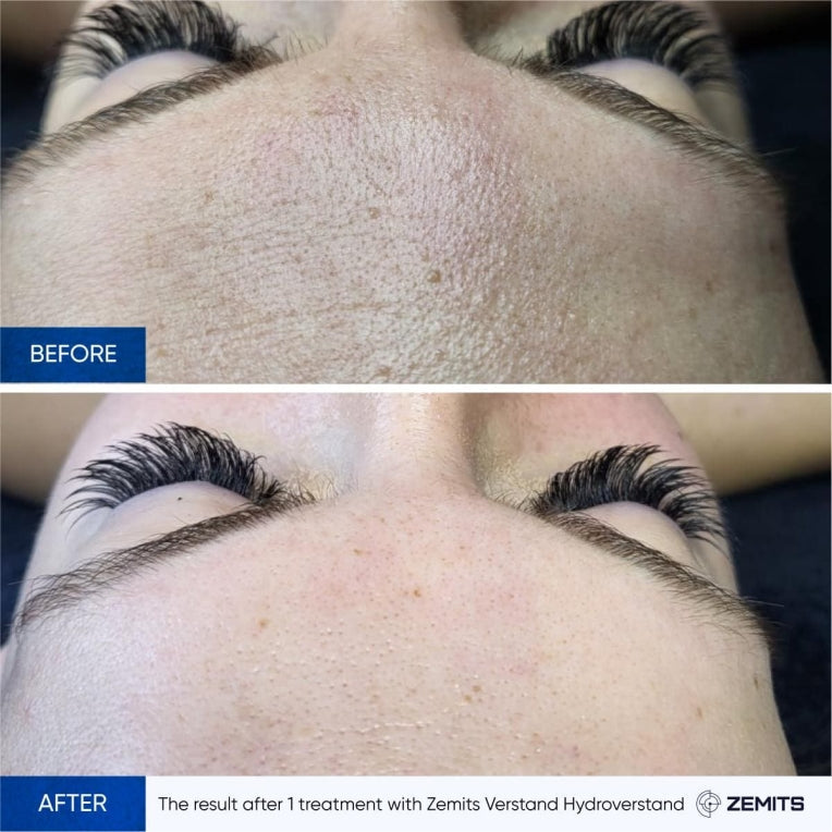 Zemits HydroVerstand PRO 7-in-1 HydroDiamond™ -järjestelmä