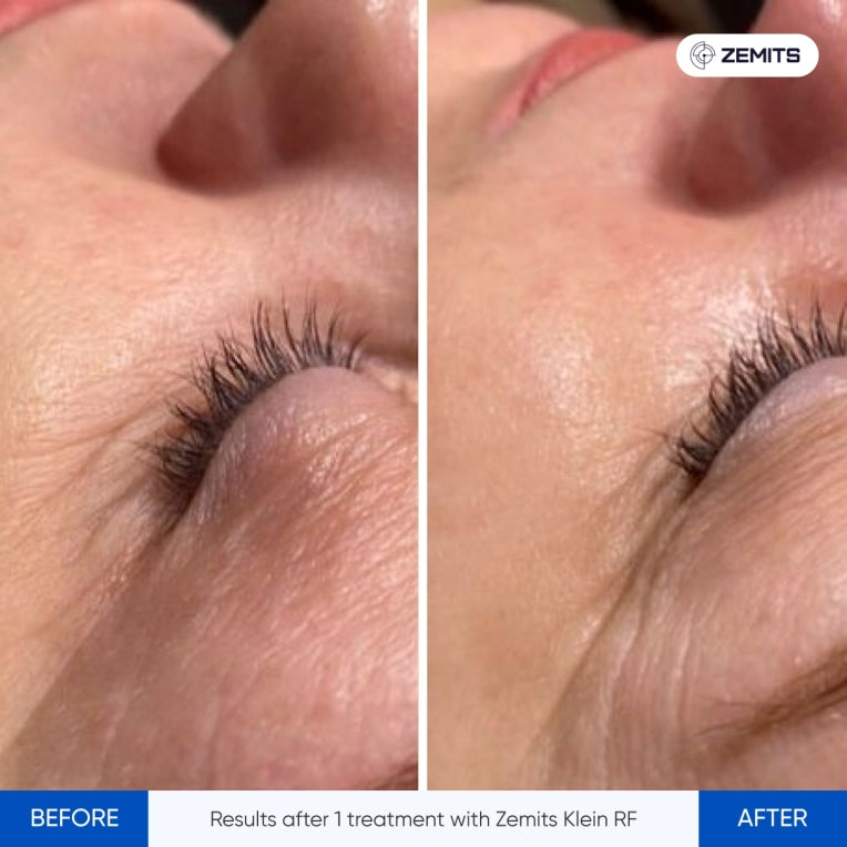 Zemits Klein RF Ihon Kiristysjärjestelmä