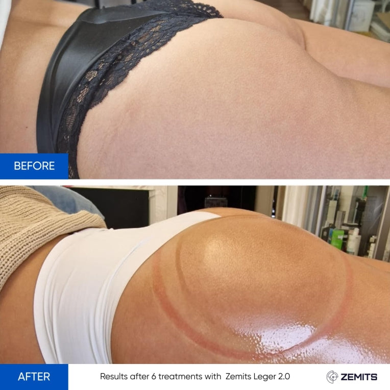 Zemits Leger 2.0 Tyhjiökuppausjärjestelmä XXL-kupeilla setissä