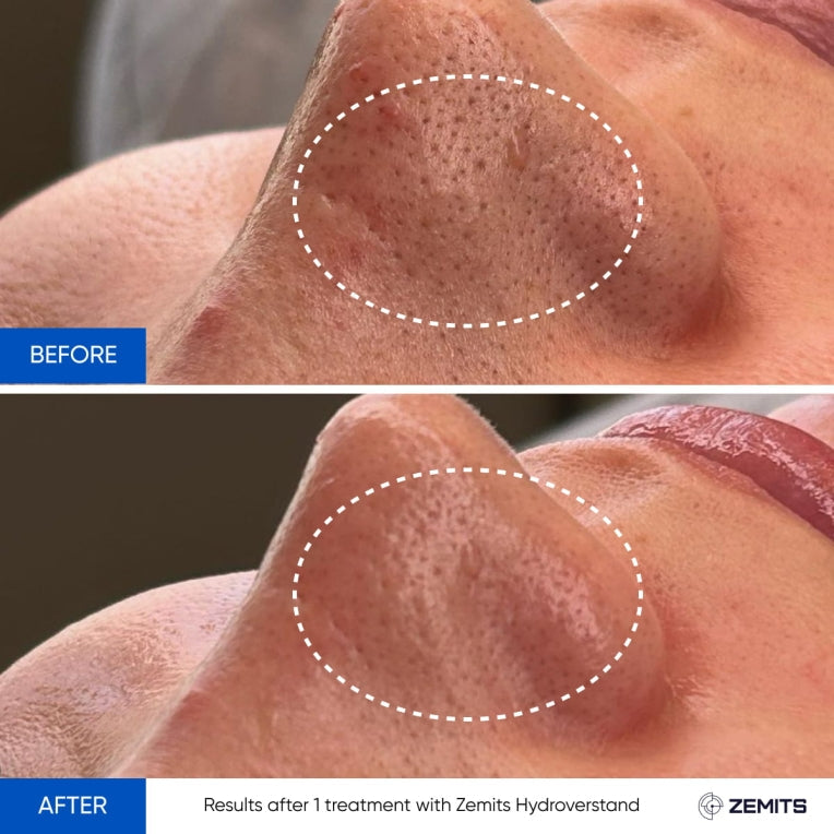 Zemits HydroVerstand PRO 7-in-1 HydroDiamond™ -järjestelmä