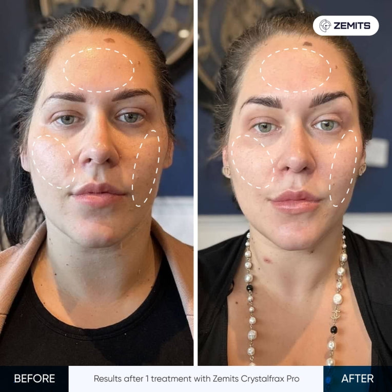 Zemits CrystalFrax PRO Ei-invasiivinen fraktionaalinen RF-järjestelmä