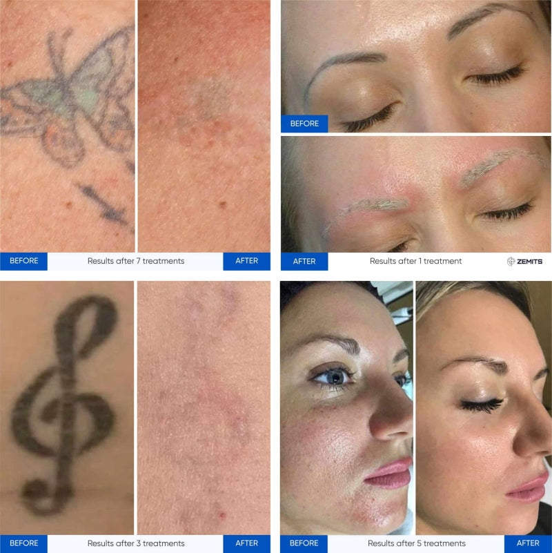 Zemits YAGenix Q-kytketty Nd:YAG-laser